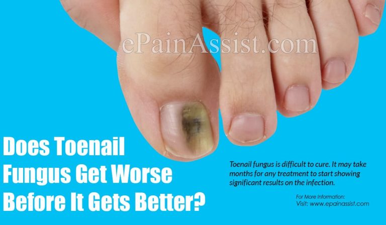 Does Toenail Fungus Get Worse Before It Gets Better?