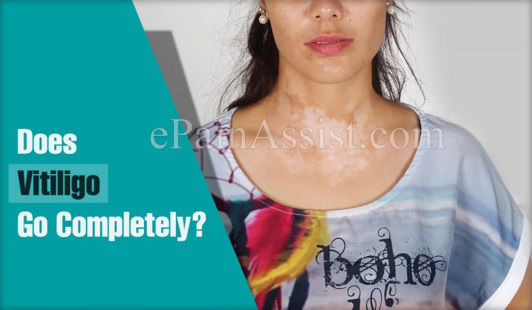 Does Vitiligo Go Completely?|What Are The Effective Treatments For Vitiligo?
