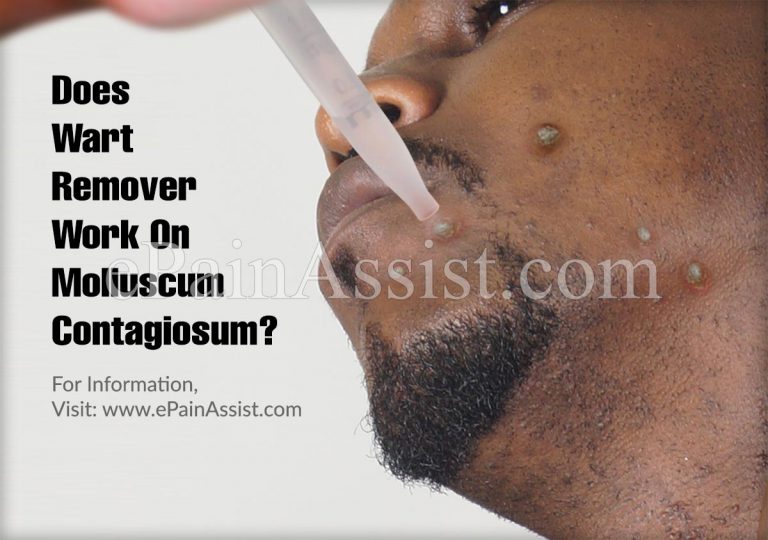 Does Wart Remover Work On Molluscum Contagiosum?