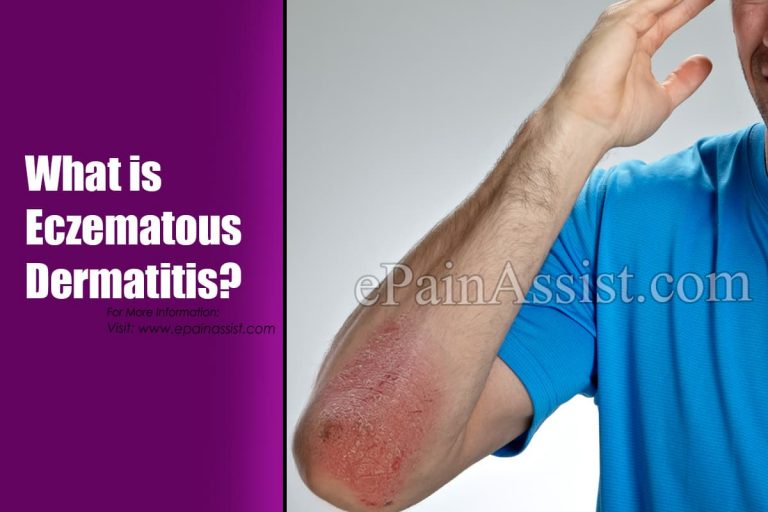 What is Eczematous Dermatitis: Causes, Symptoms, Treatments, Natural Remedies