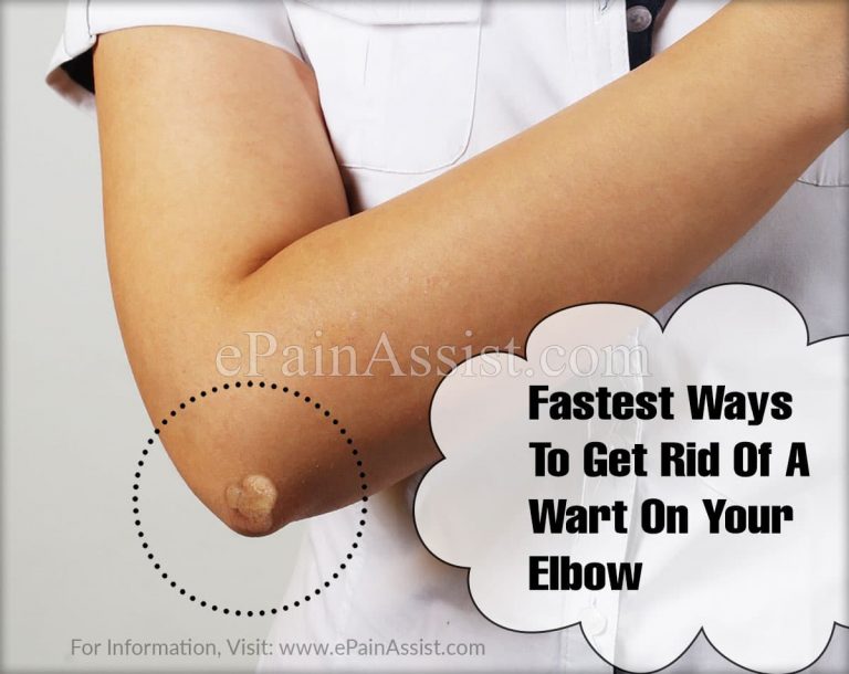 Fastest Ways To Get Rid Of A Wart On Your Elbow