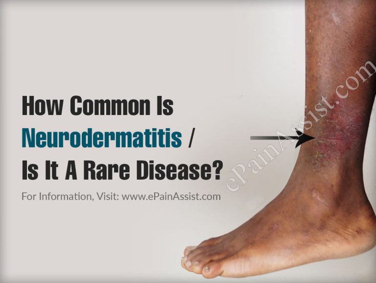 How Common Is Neurodermatitis Or Is It A Rare Disease?