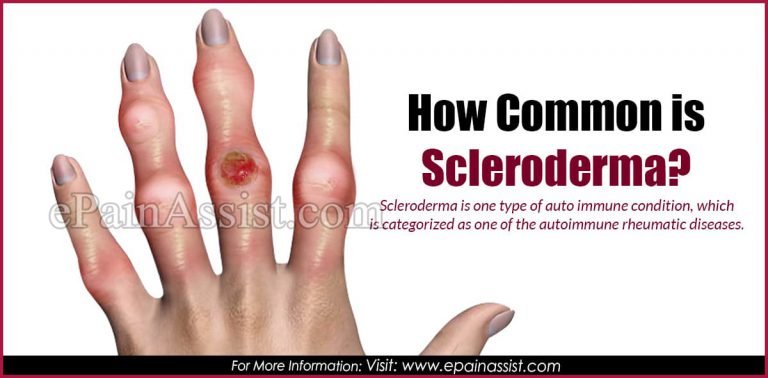 How Common Is Scleroderma?