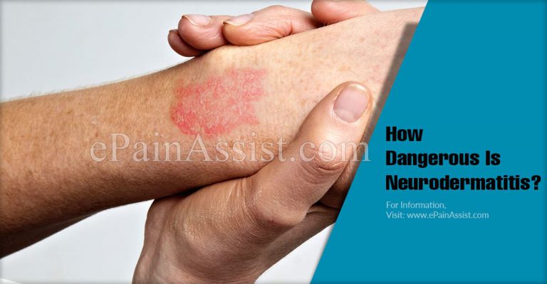 How Dangerous Is Neurodermatitis & Is It Contagious?