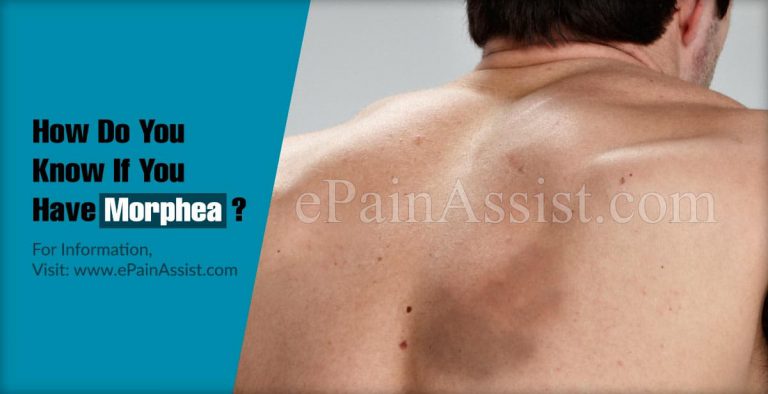 How Do You Know If You Have Morphea?