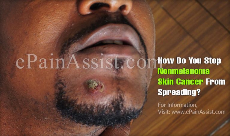 How Do You Stop Nonmelanoma Skin Cancer From Spreading?