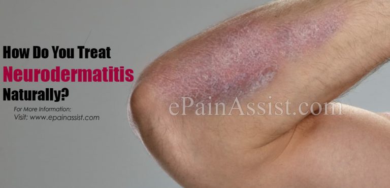 How Do You Treat Neurodermatitis Naturally?