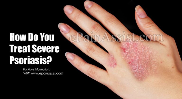 How Do You Treat Severe Psoriasis?