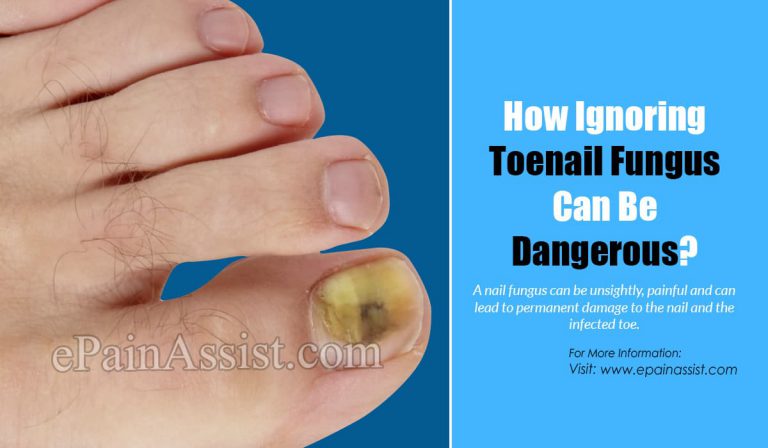 How Ignoring Toenail Fungus Can Be Dangerous?