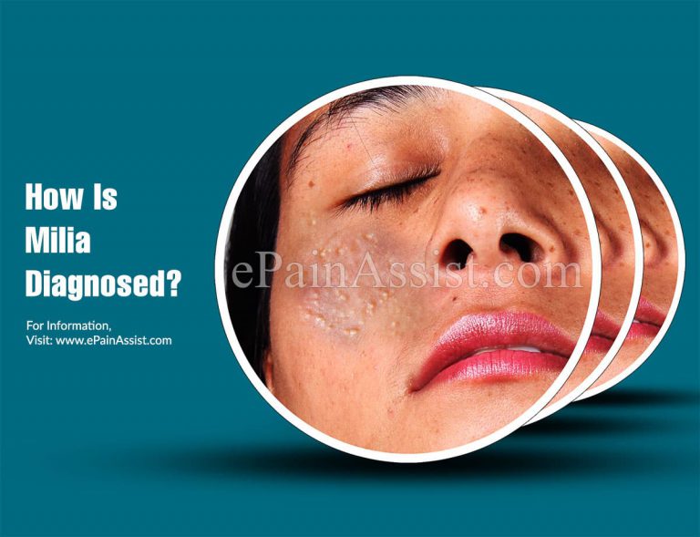 How Is Milia Diagnosed?