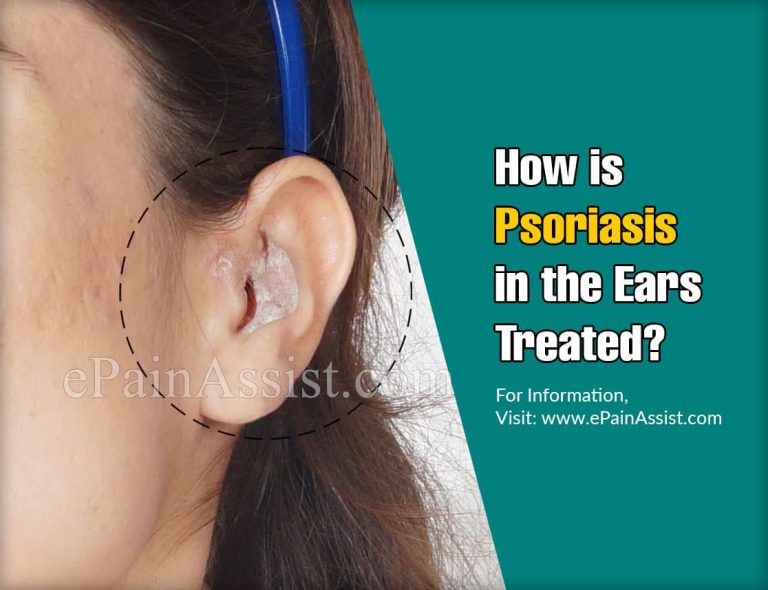 Presenting Features Of Psoriasis In The Ears & Its Treatment
