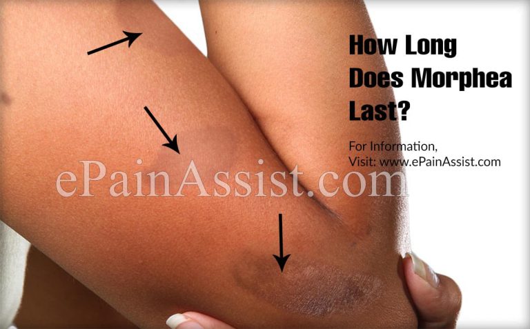 How Long Does Morphea Last?
