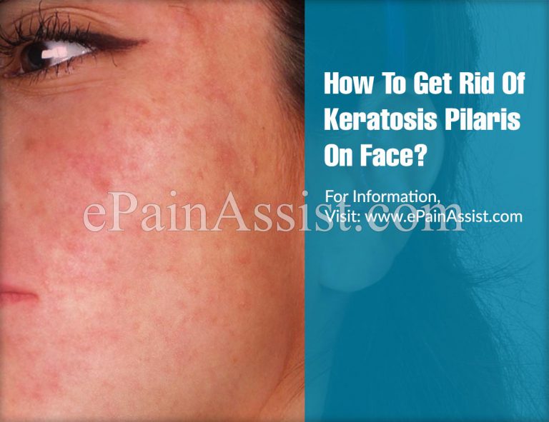 How To Get Rid Of Keratosis Pilaris On Face?