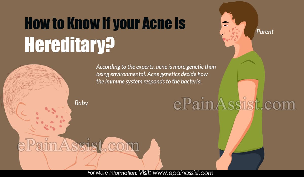 How to Know if your Acne is Hereditary?