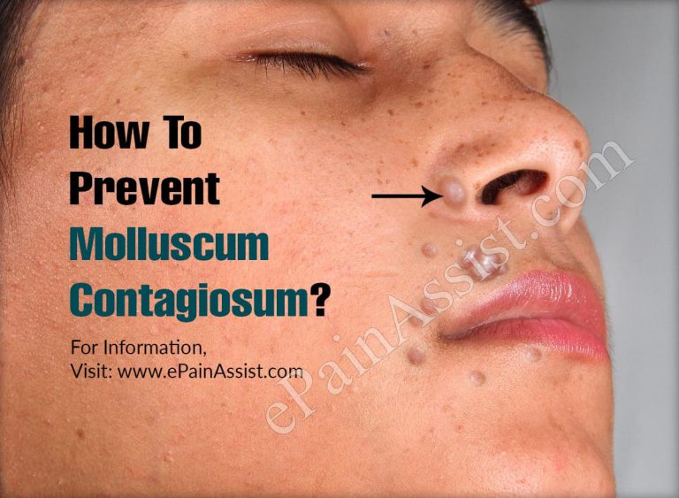 How To Prevent Molluscum Contagiosum?