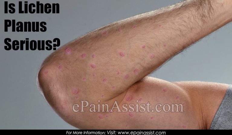 Is Lichen Planus Serious?