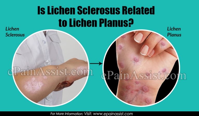 Is Lichen Sclerosus Related to Lichen Planus?