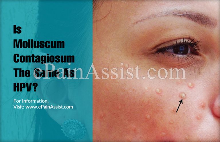 Is Molluscum Contagiosum The Same As HPV?