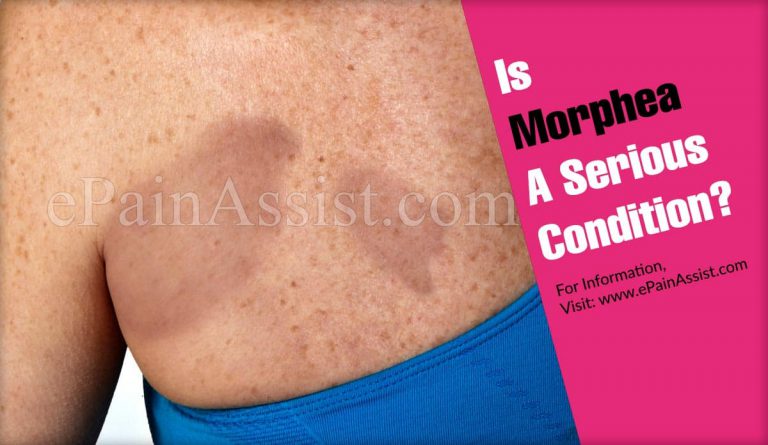 Is Morphea A Serious Condition?
