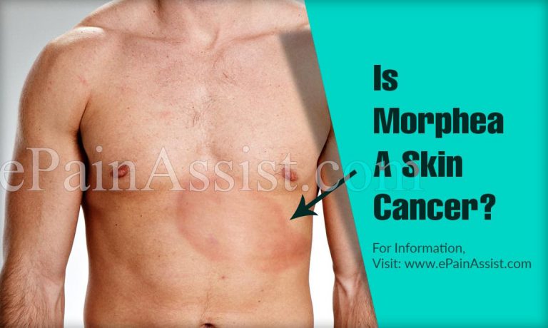 Is Morphea A Skin Cancer?