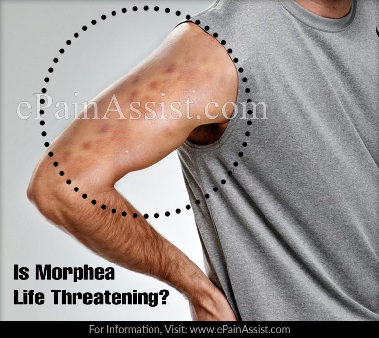 Is Morphea Life Threatening?