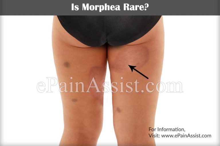 Is Morphea Rare?