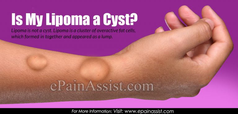 Is My Lipoma a Cyst?
