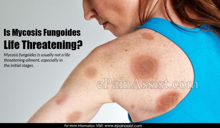 Is Mycosis Fungoides Life Threatening?