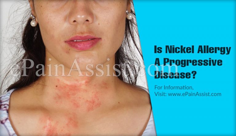 Is Nickel Allergy A Progressive Disease & Alternative Treatments For It