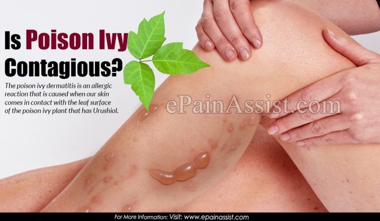 Is Poison Ivy Contagious & How Long Does Poison Ivy Last?