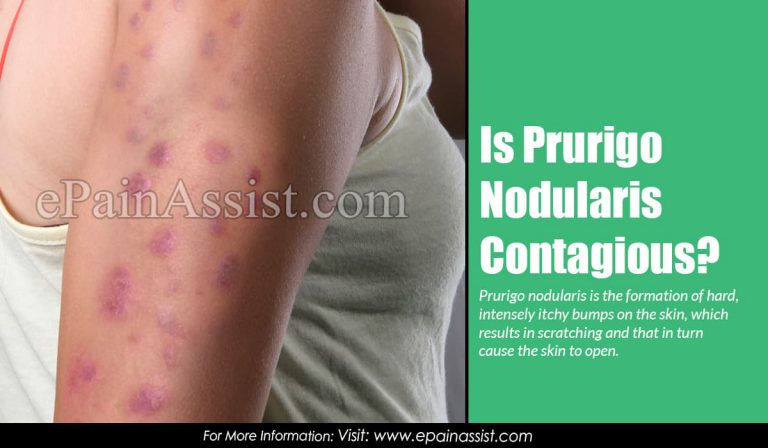 Is Prurigo Nodularis Contagious & How To Get Rid Of It?
