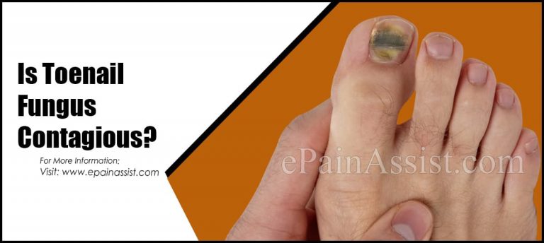 Is Toenail Fungus Contagious?