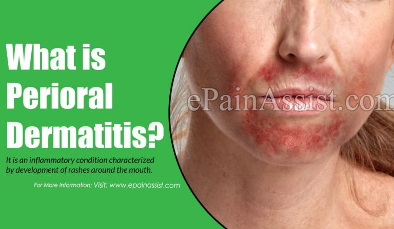 Perioral Dermatitis: Causes, Symptoms, Treatment, Natural Remedies, Prevention