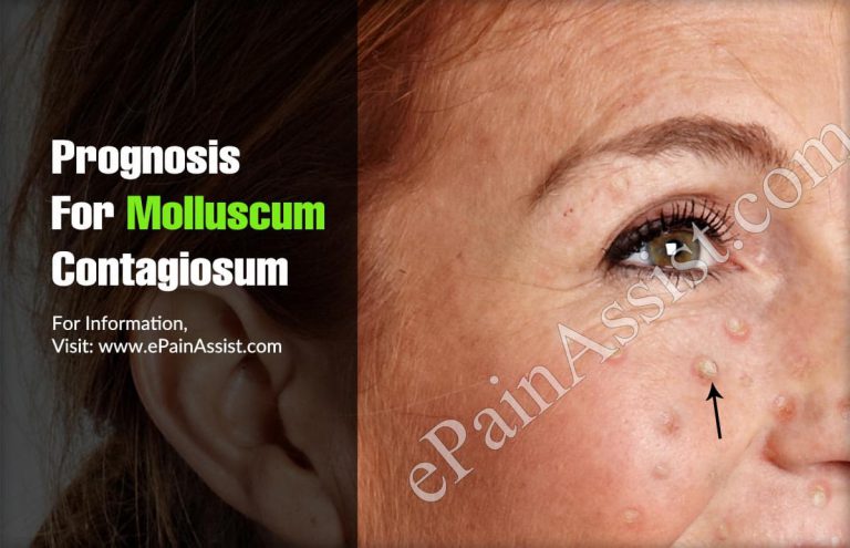Prognosis For Molluscum Contagiosum