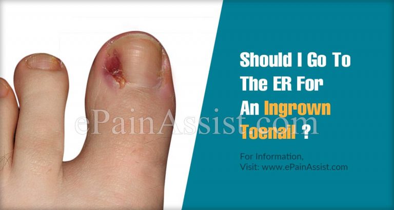 Should I Go To The ER For An Ingrown Toenail?