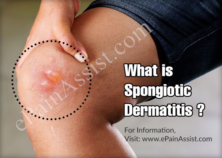 Spongiotic Dermatitis: Causes, Symptoms, Treatments, Home Remedies, Diagnosis