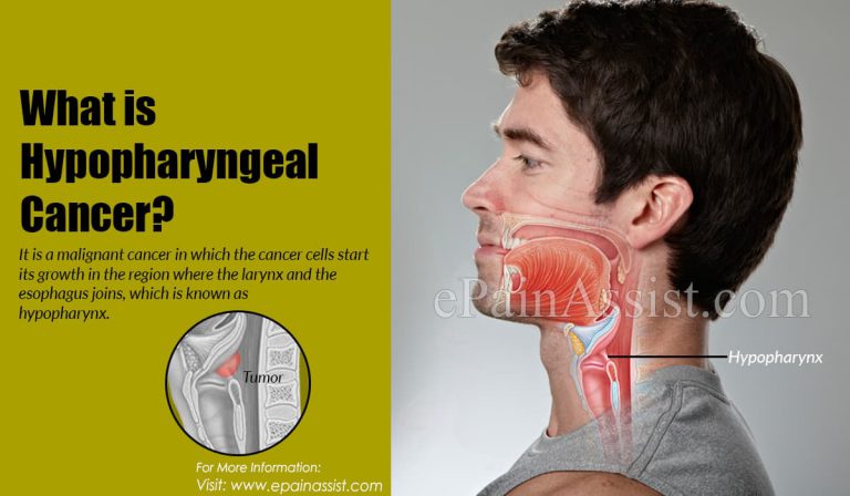 Stages of Hypopharyngeal Cancer & Its Treatment, Survival Rate, Causes, and Symptoms