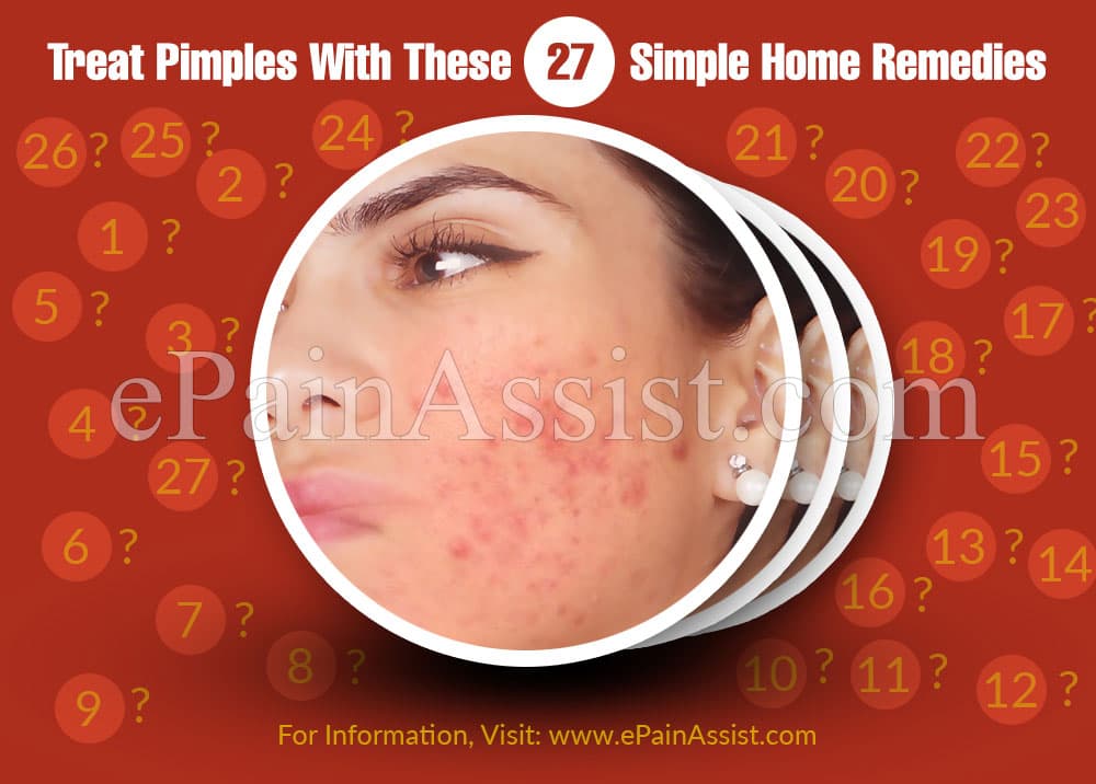 Treat Pimples With These 27 Simple Home Remedies