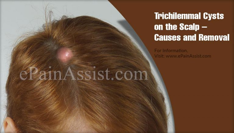 Trichilemmal Cysts on the Scalp – Causes and Removal
