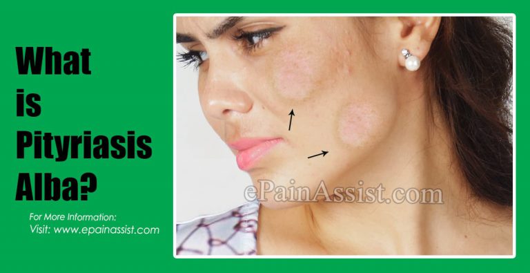 Pityriasis Alba: Causes, Symptoms, Treatment, Is it Contagious