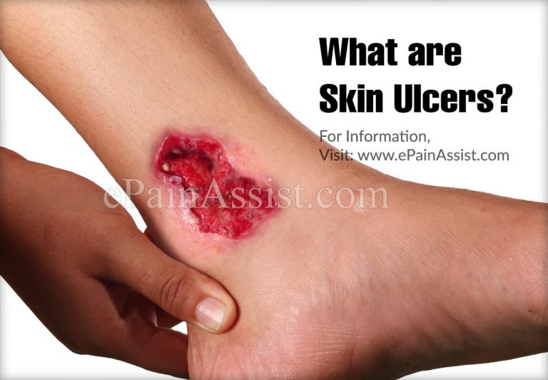 What Causes Skin Ulcer and How Is It Treated?