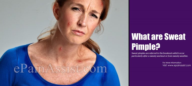 What Are Sweat Pimples & How To Get Rid Of Them?
