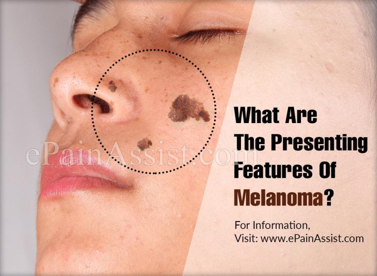 What Are The Presenting Features Of Melanoma?