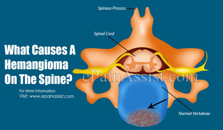 What Causes A Hemangioma On The Spine?