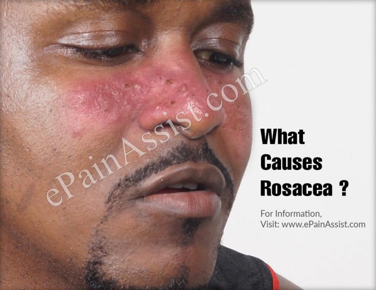 What Causes Rosacea & Does Rosacea Worsen with Age?
