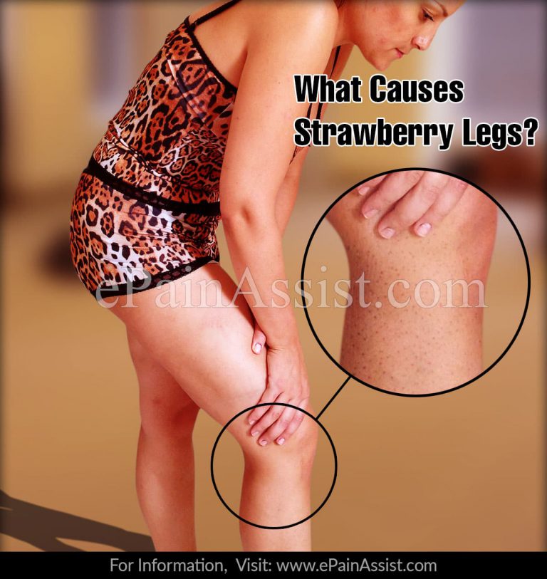 What Causes Strawberry Legs And How To Get Rid Of It?