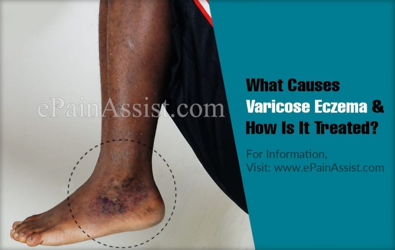 What Causes Varicose Eczema & How Is It Treated?