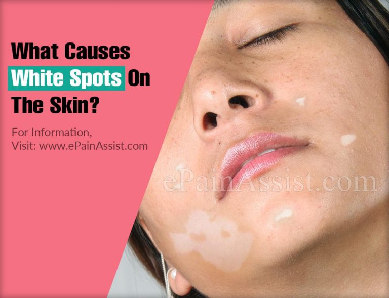 What Causes White Spots On The Skin?