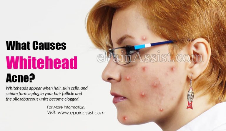 What Causes Whitehead Acne & How to Get Rid of it?