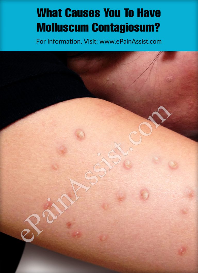 What Causes You To Have Molluscum Contagiosum?